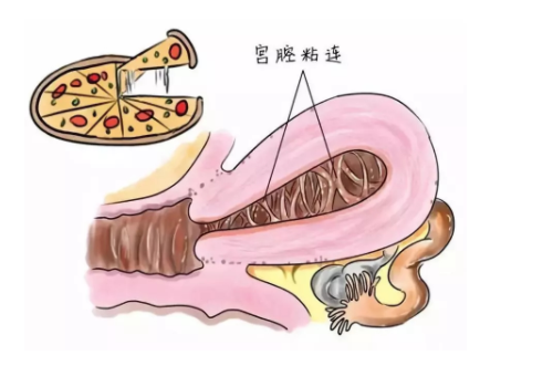 试管婴儿步骤过程详细